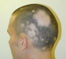 Alopecia Areata